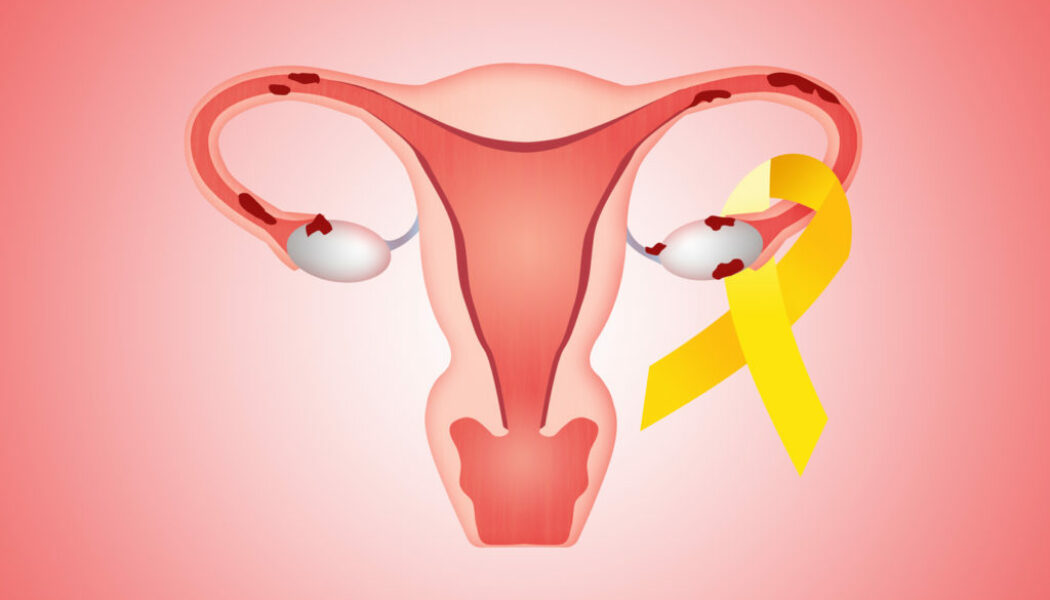 IVI y la Fundación Salud 2000 han donado 25.000 euros para la investigación de nuevos fármacos para la endometriosis