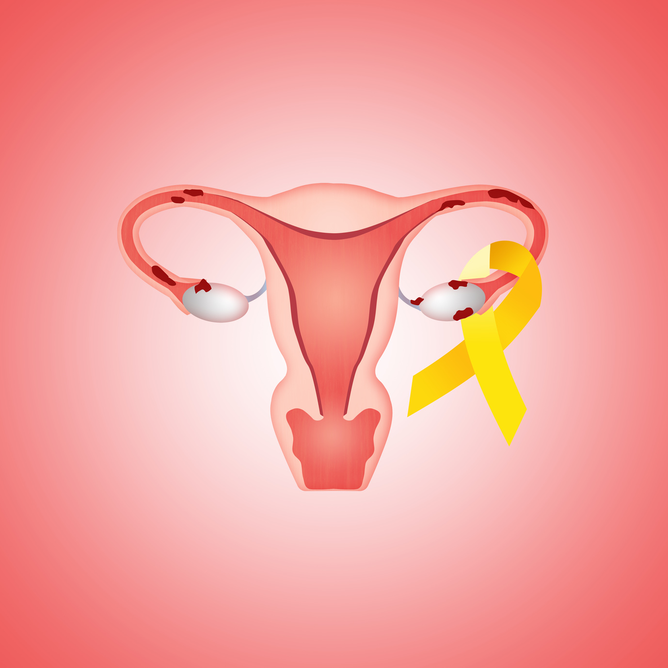 IVI y la Fundación Salud 2000 han donado 25.000 euros para la investigación de nuevos fármacos para la endometriosis