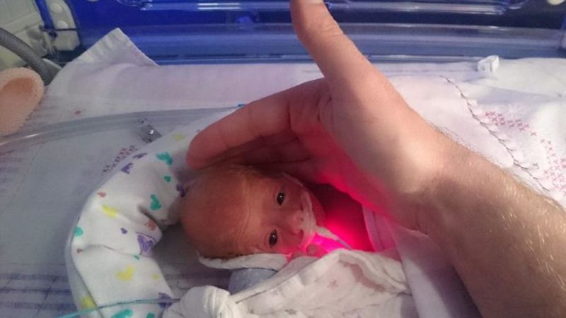 Un médico salva la vida a un bebé prematuro de solo 28 semanas al envolverlo en una bolsa de bocadillos.