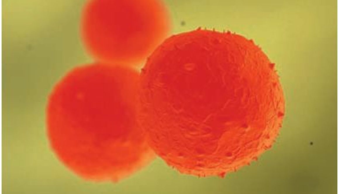 Alentadores resultados en el tratamiento con células madre de la fístula de Crohn