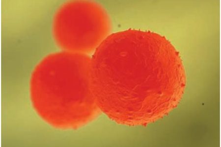 Alentadores resultados en el tratamiento con células madre de la fístula de Crohn