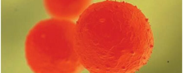 Alentadores resultados en el tratamiento con células madre de la fístula de Crohn