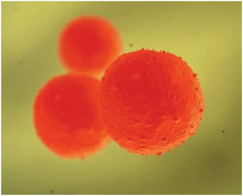 Alentadores resultados en el tratamiento con células madre de la fístula de Crohn