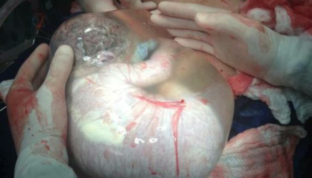 Bebé nacido con el saco amniótico sin romper: un parto se hace viral