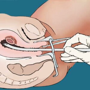 ¿Abortos sin explicación? Estudio revela nuevas soluciones ¿Abortos sin explicación? Estudio revela nuevas soluciones