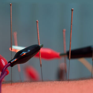 ¿Acupuntura para la fecundación in vitro?