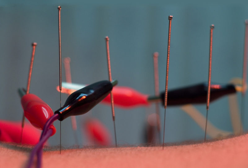 ¿Acupuntura para la fecundación in vitro?