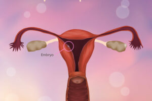 ¿Cómo mejorar la implantación embrionaria en el tratamiento de fertilidad?