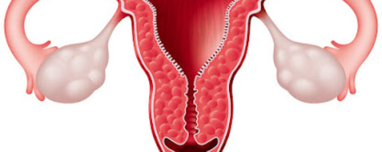 ¿Que es un ovario poliquístico?