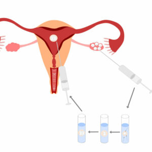 Como mejorar el grosor del endometrio