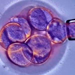 Diagnóstico Genético Preimplantacional DGP