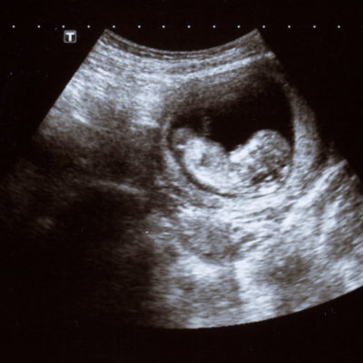 Ecografía Embarazo