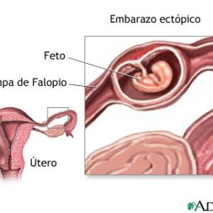 El embarazo ectópico