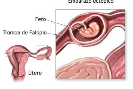 El embarazo ectópico