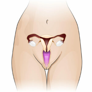 Endometriosis, adenomiosis e infertilidad