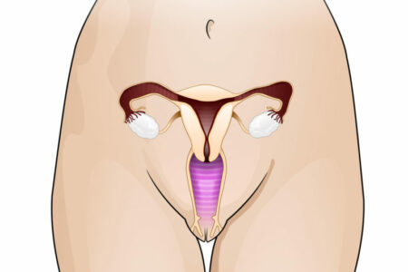 Endometriosis, adenomiosis e infertilidad