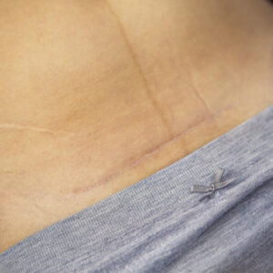 Indemnizan a una paciente a la que dejaron dentro una gasa