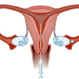 La Inseminación Artificial Conyugal (IAC)