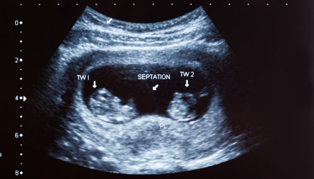 La UR Vistahermosa explica por qué es importante evitar los embarazos múltiples