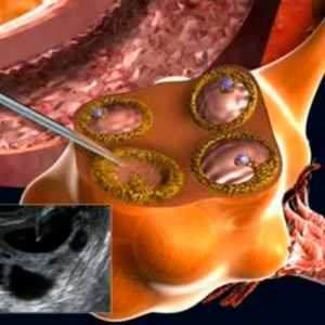 La estimulación ovárica