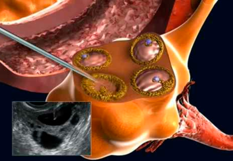 La estimulación ovárica
