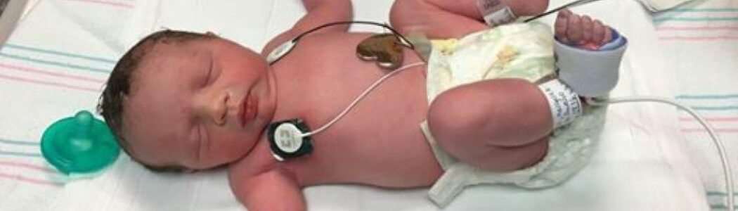 La operación extrema de un tumor que hizo a este bebé nacer dos veces