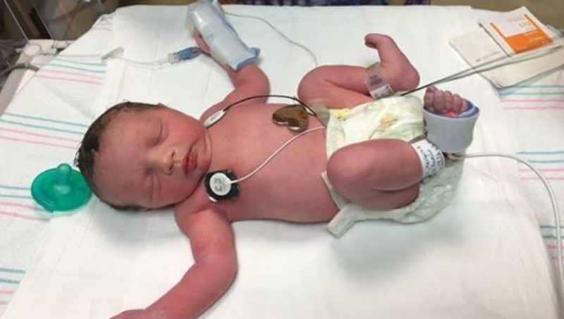 La operación extrema de un tumor que hizo a este bebé nacer dos veces