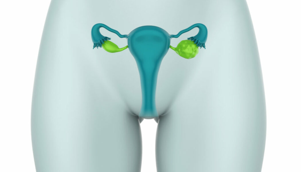 Los pólipos endometriales: Síntomas,diagnóstico y tratamientos