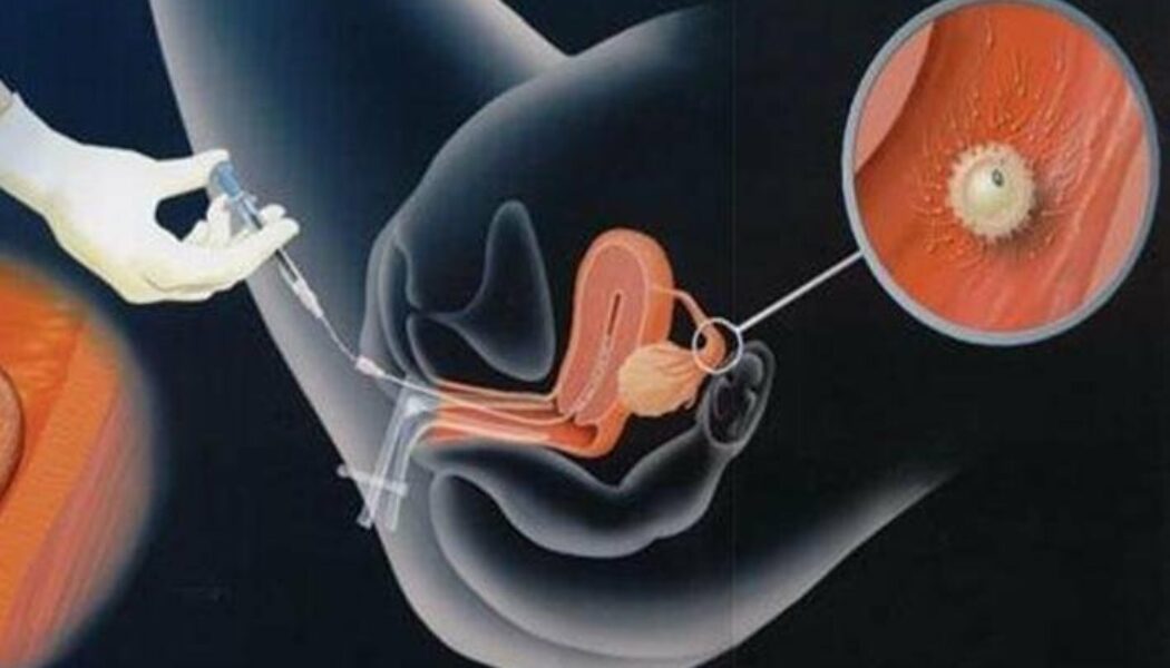 Los riesgos y los beneficios de la inseminación artificial