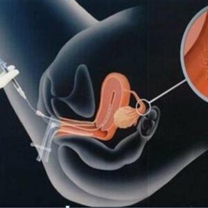 Los riesgos y los beneficios de la inseminación artificial