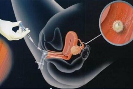 Los riesgos y los beneficios de la inseminación artificial