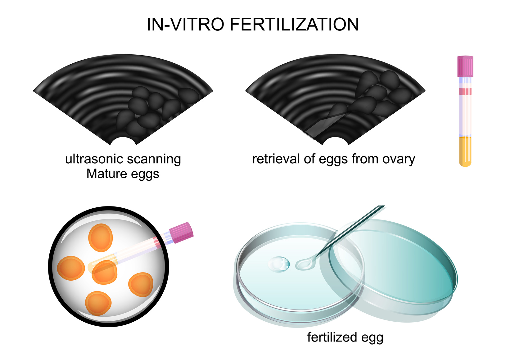 Medicación previa a la fecundación in vitro