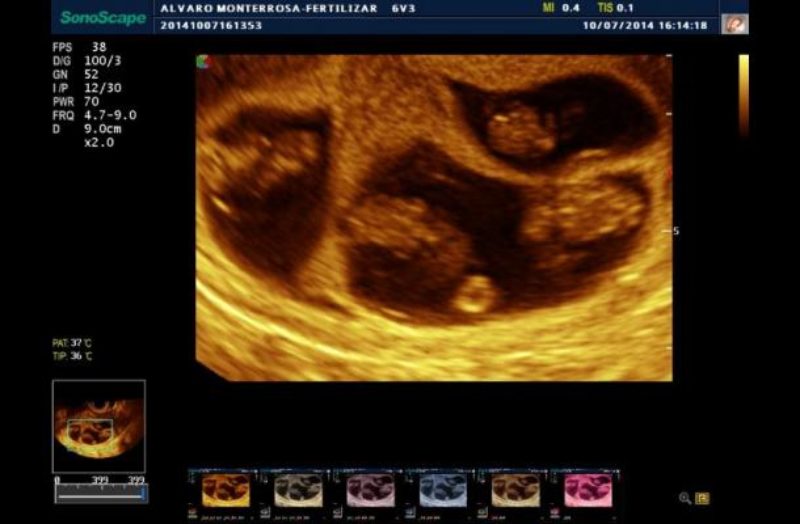 Nacen en Cartagena cuatrillizos