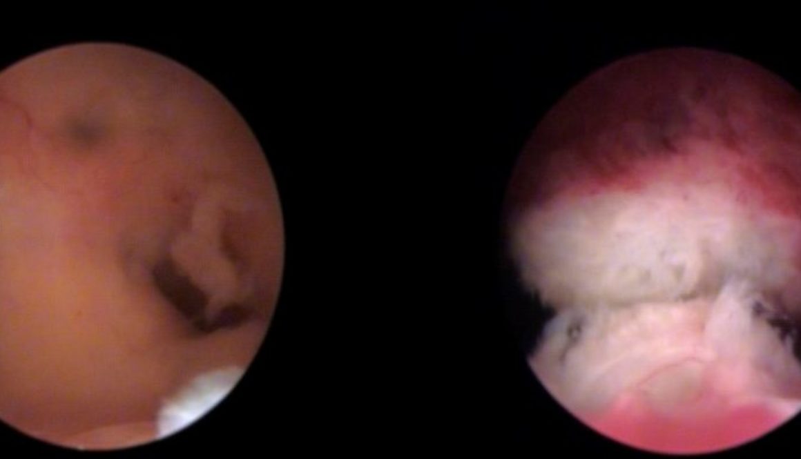 Nueva unidad IB para el diagnóstico y tratamiento reproductivo del Síndrome de Asherman