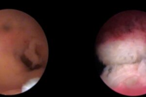 Nueva unidad IB para el diagnóstico y tratamiento reproductivo del Síndrome de Asherman