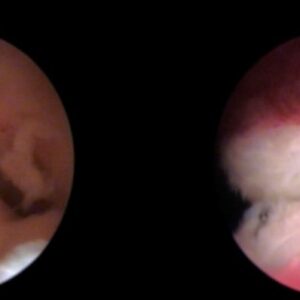 Nueva unidad IB para el diagnóstico y tratamiento reproductivo del Síndrome de Asherman