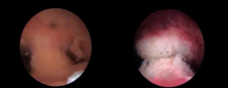 Nueva unidad IB para el diagnóstico y tratamiento reproductivo del Síndrome de Asherman