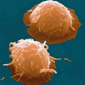 Nuevo ensayo clínico en marcha para el tratamiento de la artrosis usando células madre