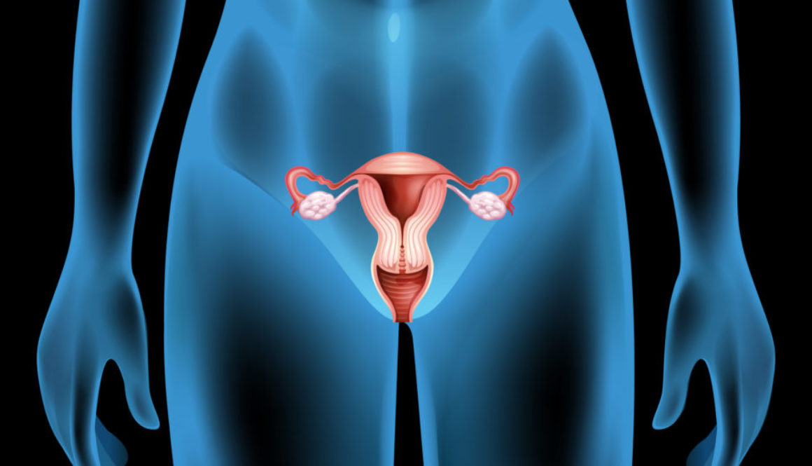 PCOS - Ovarios Poliquisticos