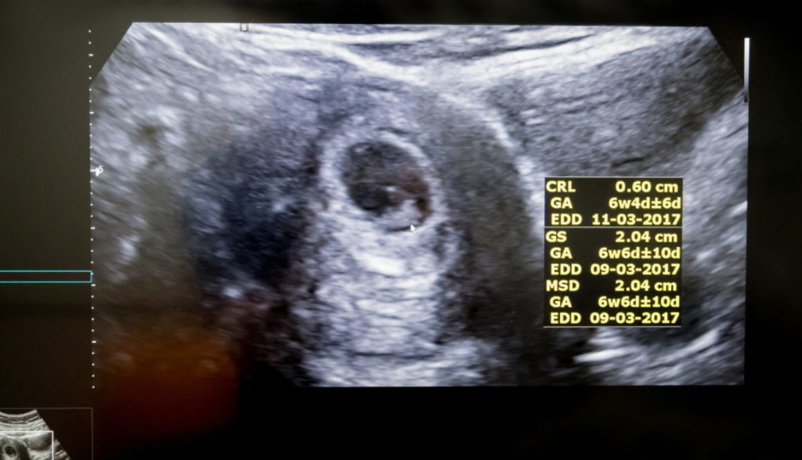 Primera Ecografía de embarazo tras los Tratamientos de Fertilización in Vitro
