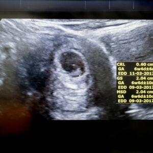 Primera Ecografía de embarazo tras los Tratamientos de Fertilización in Vitro