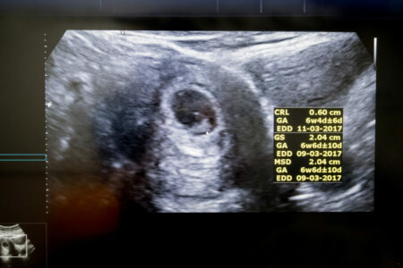 Primera Ecografía de embarazo tras los Tratamientos de Fertilización in Vitro