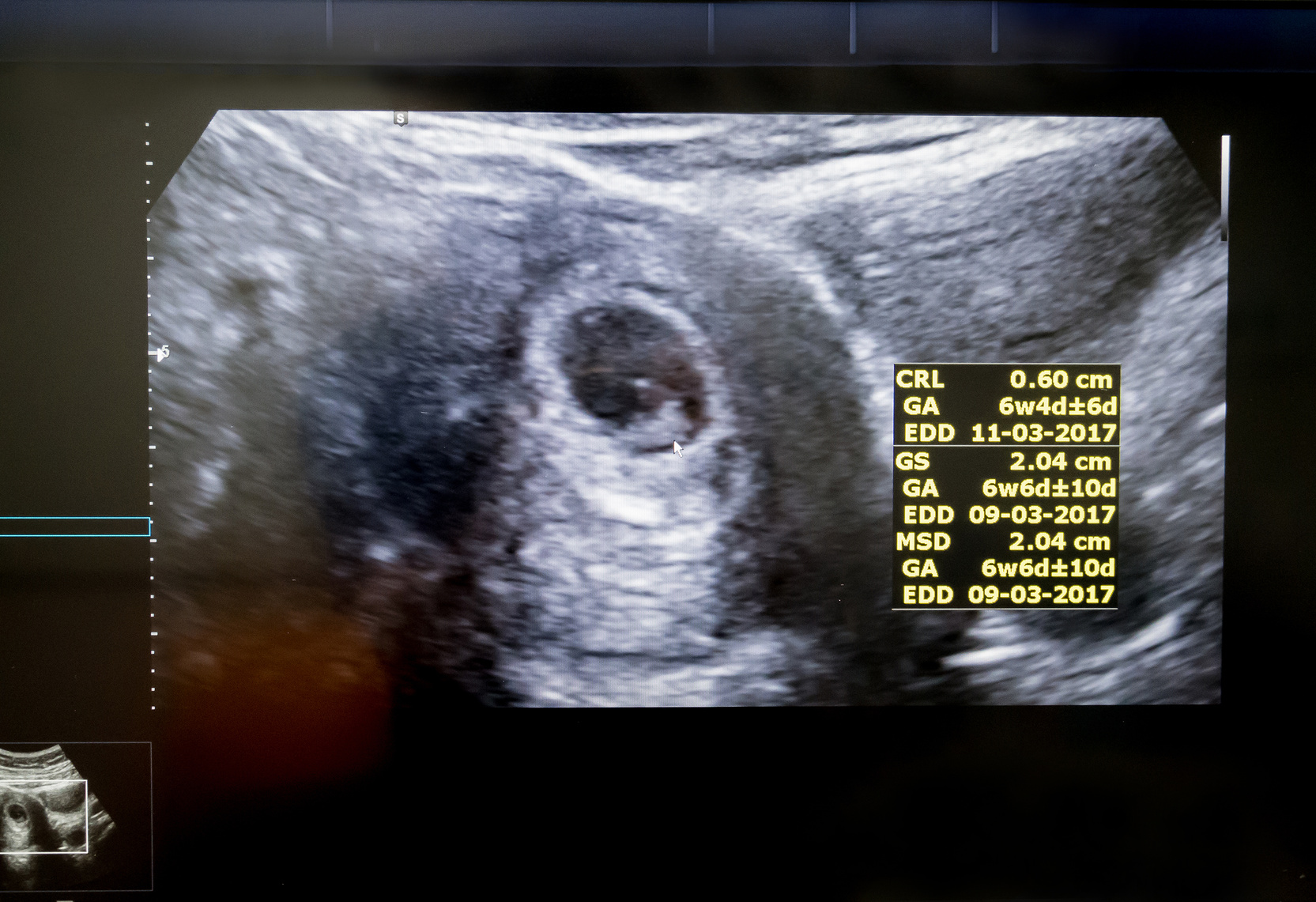 Primera Ecografía de embarazo tras los Tratamientos de Fertilización in Vitro
