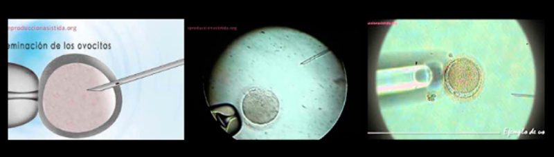 Proceso de Microinyección espermática o ICSI