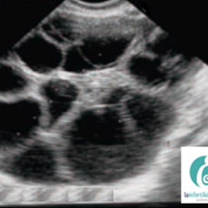 Qué es la punción ovárica, paso a paso