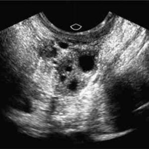 Síndrome del Folículo vacío
