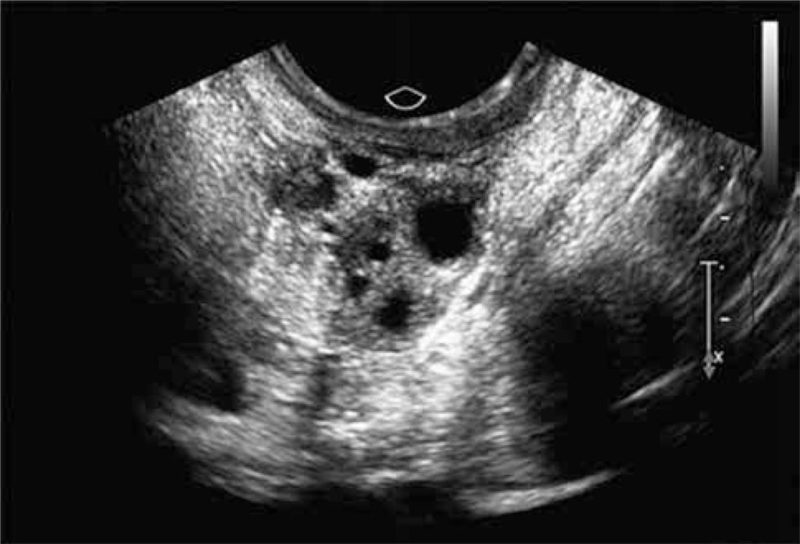 Síndrome del Folículo vacío