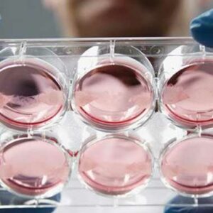 Se utilizan celulas madre de la sangre menstrual de la propia paciente para tratar el síndrome de Asherman