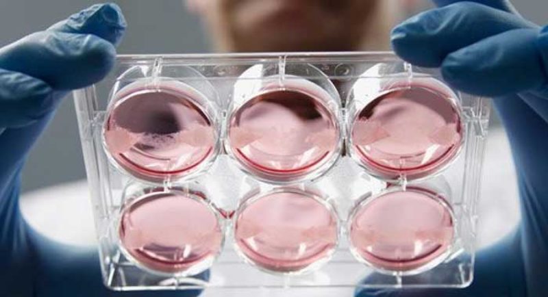 Se utilizan celulas madre de la sangre menstrual de la propia paciente para tratar el síndrome de Asherman