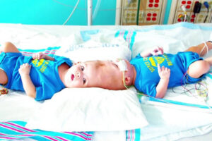 Separan con éxito a dos bebés siameses unidos por la cabeza